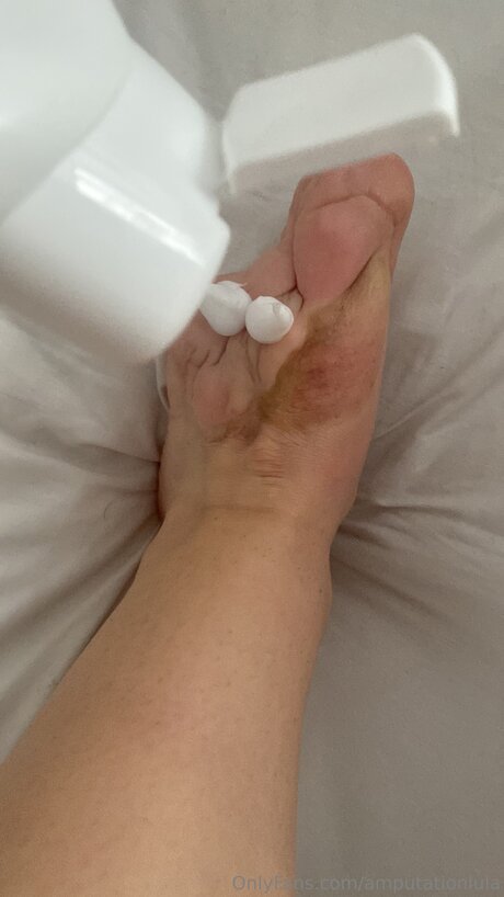 Amputationlula beste top bilder